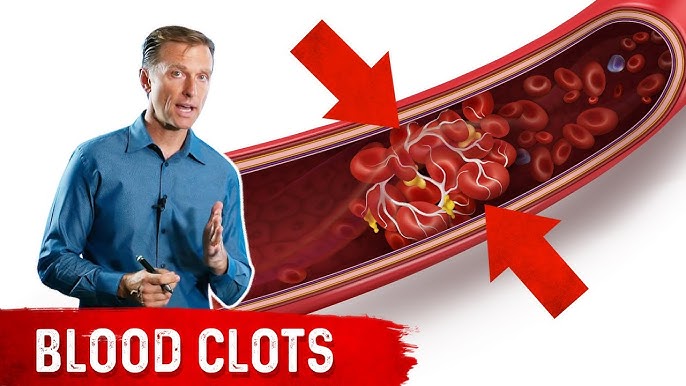 Nutrients That Naturally Dissolve Blood Clots – Doctors Don’t Share Tip…